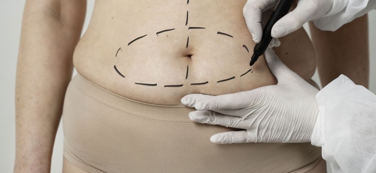 Is Mini Tummy Tuck Enough or Will You Need More?
