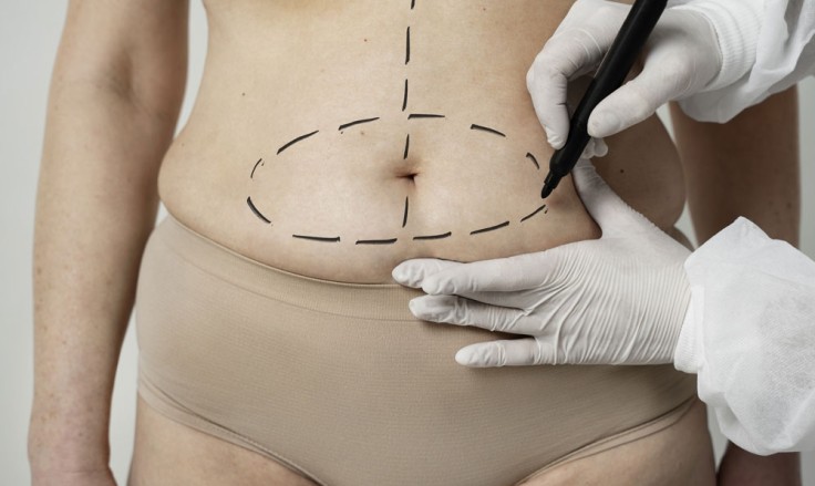 Is Mini Tummy Tuck Enough or Will You Need More?