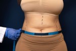 Full Tummy Tuck vs Mini Tummy Tuck: What's The Difference? 