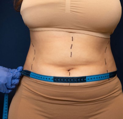 Quelle est la différence entre une abdominoplastie complète et une mini abdominoplastie ?