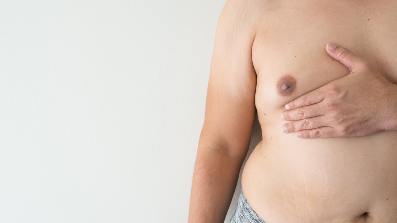 7 Common Questions About Gynecomastia