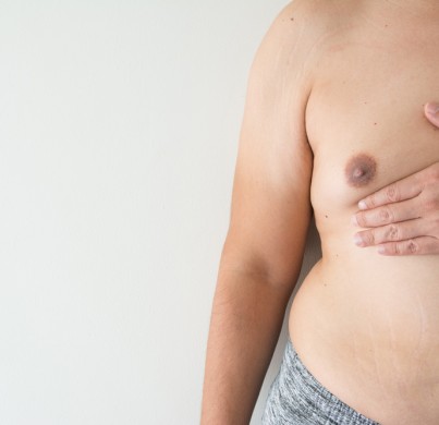 7 Common Questions About Gynecomastia
