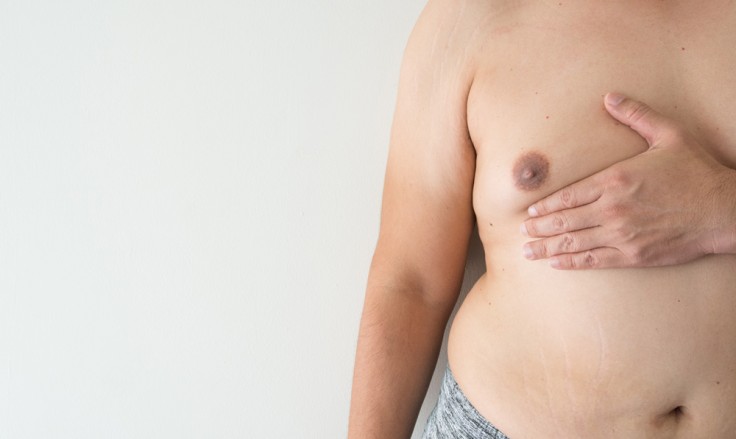 7 Common Questions About Gynecomastia