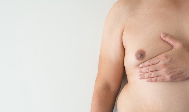 Gynecomastia in Istanbul: 5 Things to Know