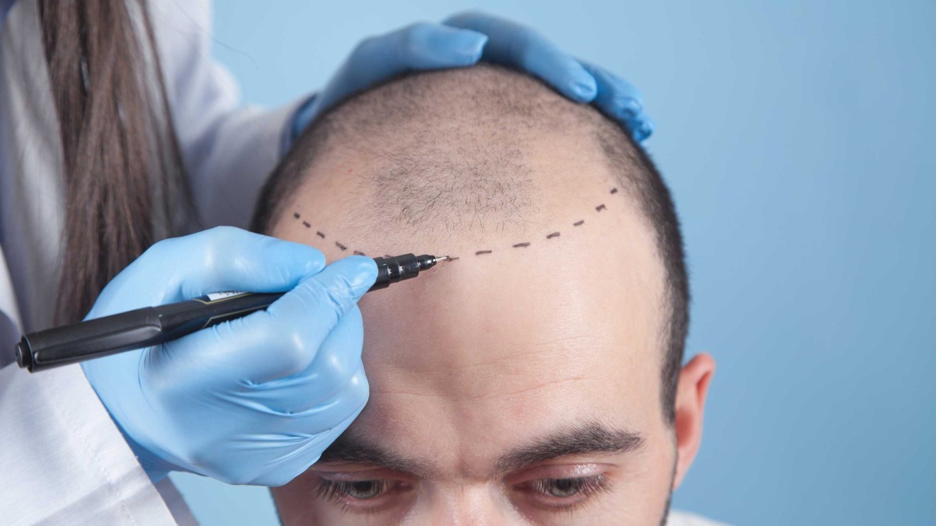 Soins post-greffe : comment entretenir vos nouveaux cheveux