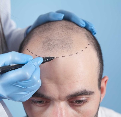 Post-Transplant Care: How to Maintain Your New Hair