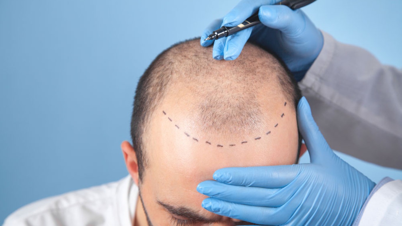 Combien de temps dure la récupération après une greffe de cheveux ?