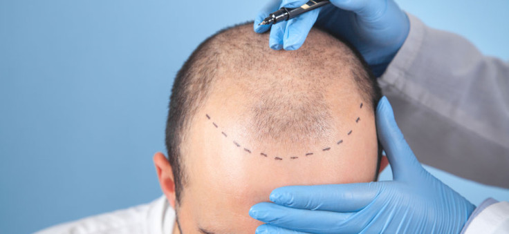 Die besten Länder für Haartransplantation: Warum ist die Türkei so beliebt?