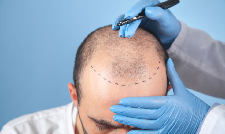 Best Countries for Hair Transplant: Why is Turkey Popular?