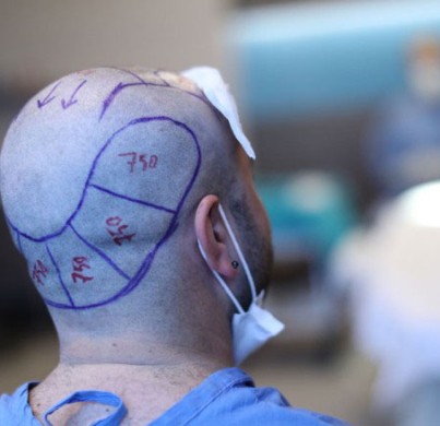 Lo que hay que saber sobre el trasplante capilar en Turquía