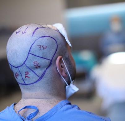 Que faire avant une greffe de cheveux en Turquie 