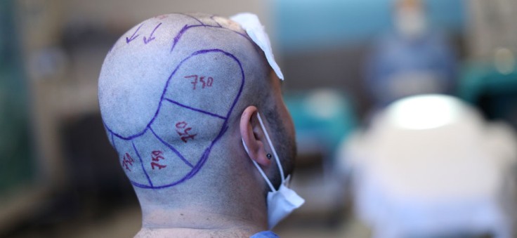 Was Sie vor einer Haartransplantation in der Türkei tun sollten