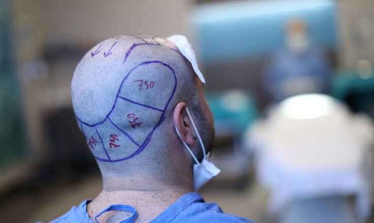 Was Sie vor einer Haartransplantation in der Türkei tun sollten