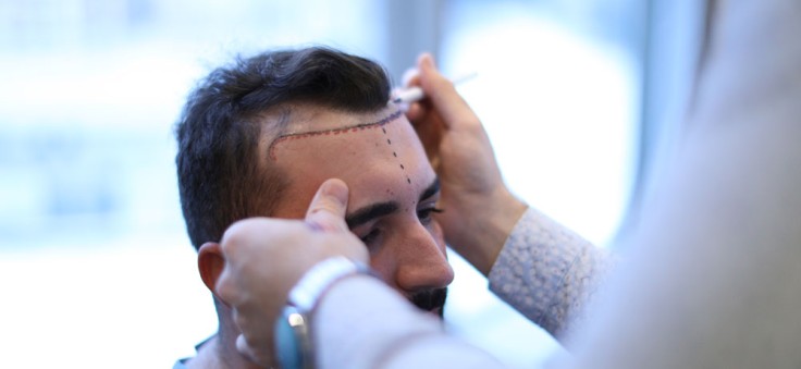 Wie viel kostet eine Haartransplantation in der Türkei?