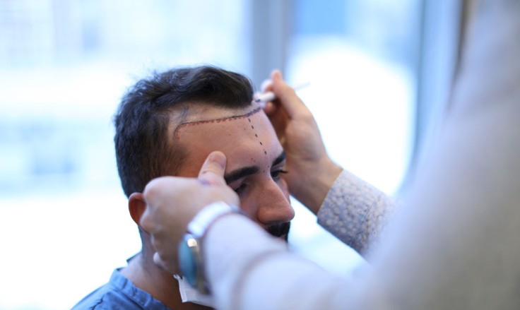 ¿Cuánto vale un trasplante de pelo en Turquía?