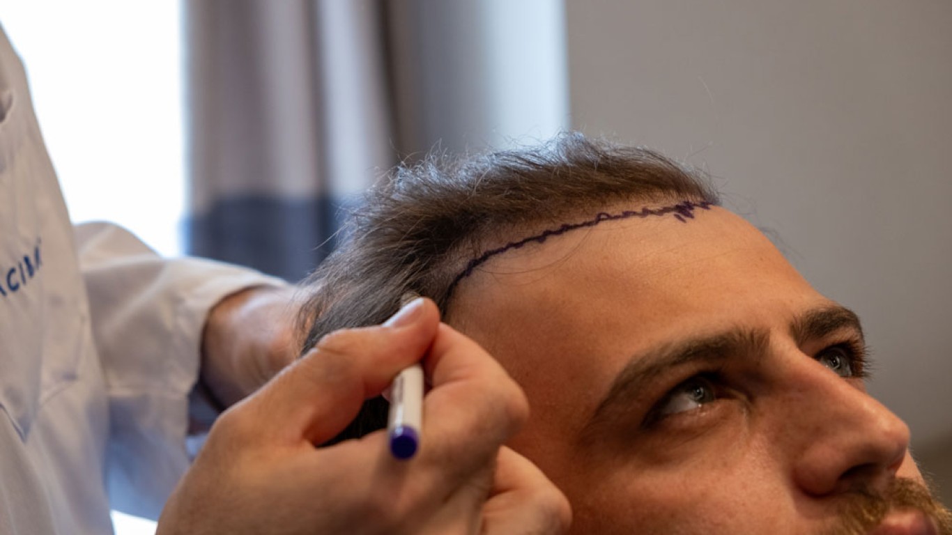 How to Take Care of Your Hair After a Hair Transplant?