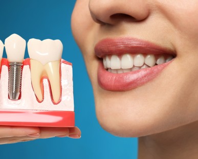7 avantages des implants dentaires : un sourire solide, naturel et durable