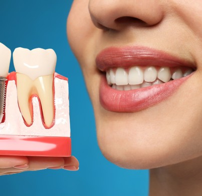 Coronas de confianza: El impacto de los implantes dentales