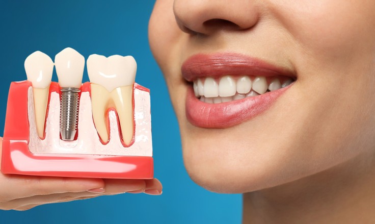 Coronas de confianza: El impacto de los implantes dentales