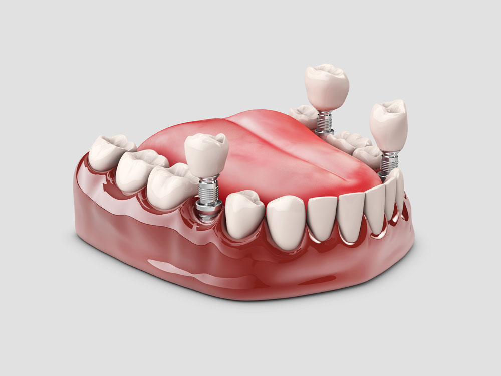 implants dentaires