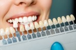 Láminas de porcelana vs. coronas de zirconio: una comparativa estética