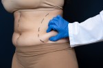 Laser-Liposuktion in der Türkei: Was erwartet Sie, Kosten, Ablauf