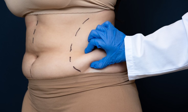 Laser-Liposuktion in der Türkei: Was erwartet Sie, Kosten, Ablauf