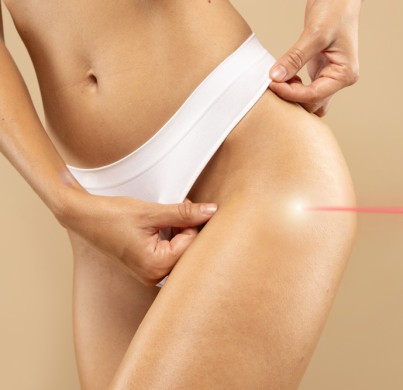 Laser Stretch Mark Removal in Turkey: Options That Work