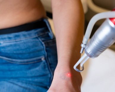 Laser-Tattooentfernung in Istanbul: Was Sie wissen sollten