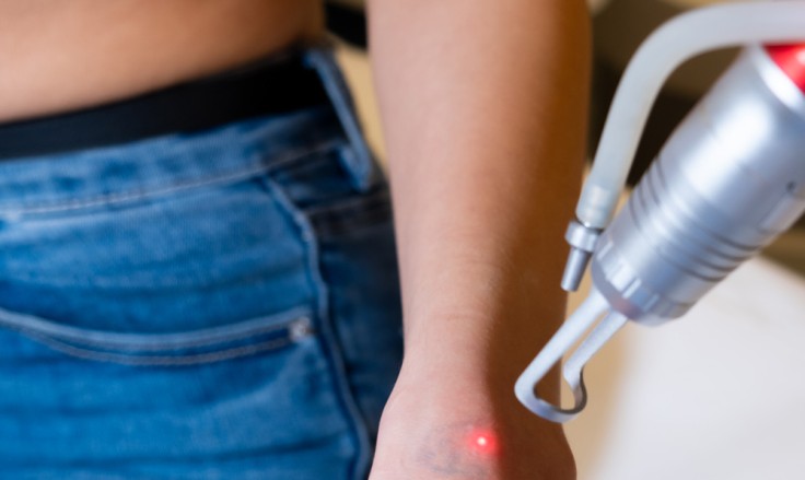 Laser Tattoo Removal in Istanbul: What You Should Know