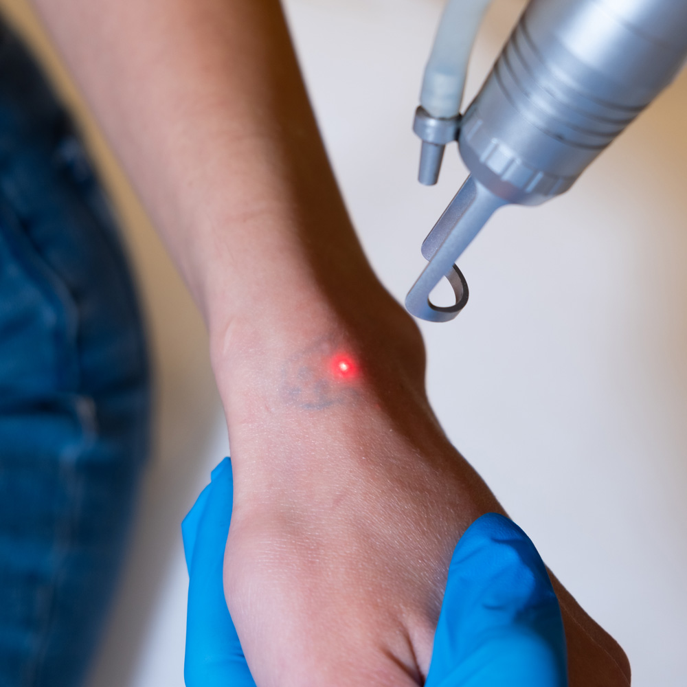 Laser Tattoo Removal