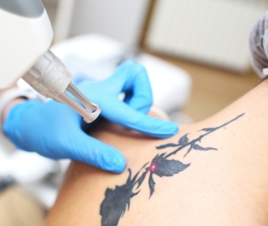 Laser Tattoo Removal