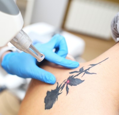 Laser Tattoo Removal