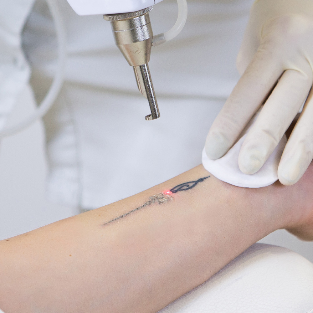 How Many Sessions for Laser Tattoo Removal?
