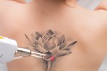 How Many Sessions for Laser Tattoo Removal?