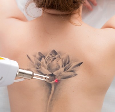 How Many Sessions for Laser Tattoo Removal?