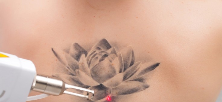 How Many Sessions for Laser Tattoo Removal?