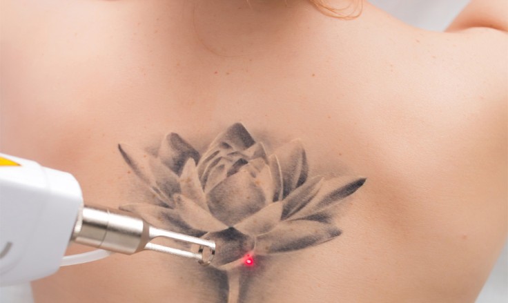 How Many Sessions for Laser Tattoo Removal?