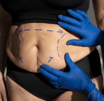 Liposucción: El arte de esculpir el cuerpo