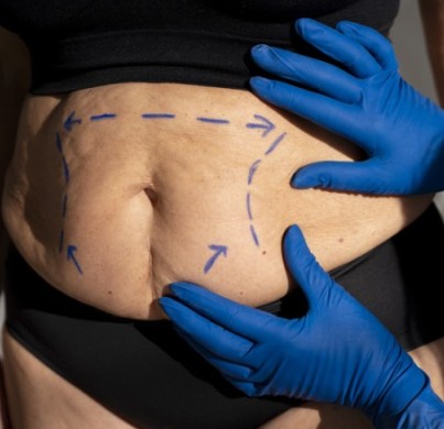 Liposucción: Gestión de expectativas y resultados realistas