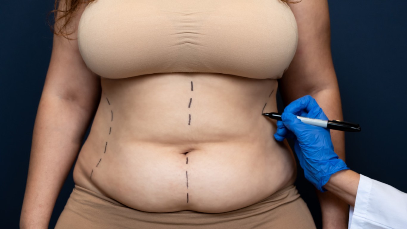 El dilema en el contorno de cuello: Elige entre la liposucción o levantamiento de cuello