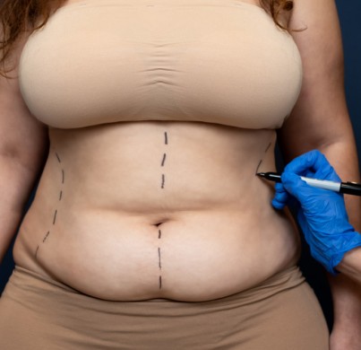 El dilema en el contorno de cuello: Elige entre la liposucción o levantamiento de cuello