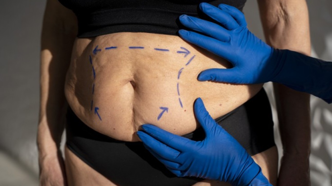 Was sind die Vorteile einer Liposuktion in der Türkei?