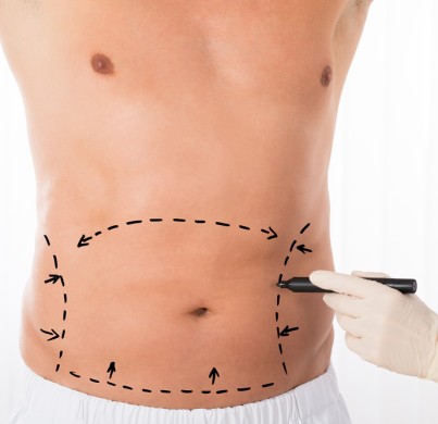 What to Know: Liposuction Surgery Tips