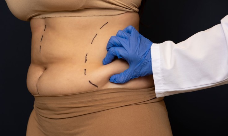 Stomach Liposuction Cost in 2026 and Treatment Scope