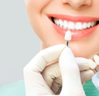 ¿Cuánto Duran las Carillas Dentales de Porcelana?