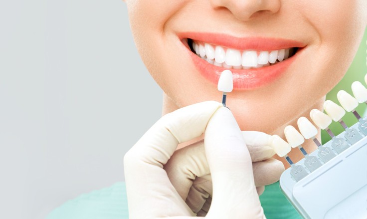 8 curiosidades sobre los veneers dentales