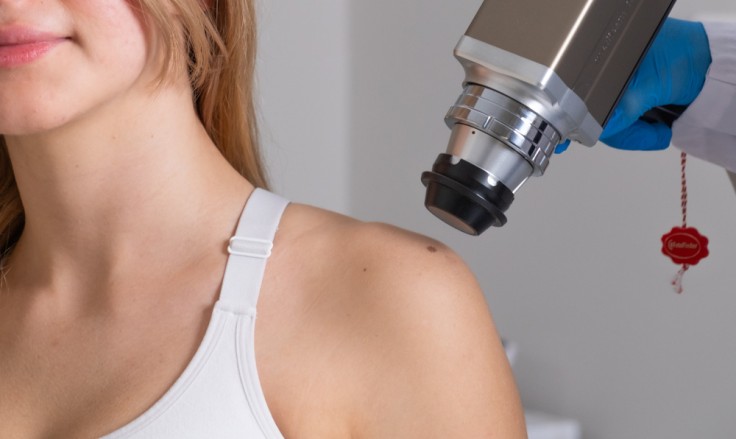Everything You Need to Know About Mole Removal