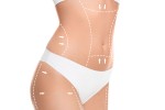 What to Expect in a Mommy Makeover Consultation