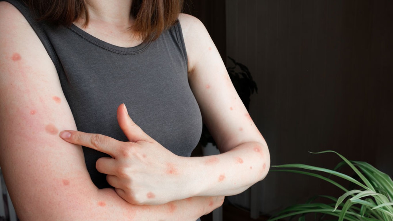 Tout ce que vous devez savoir sur la mpox